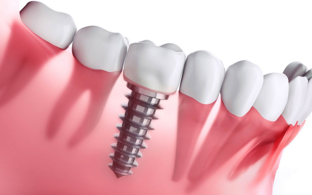 Dental Implant
