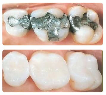 Tooth Fillings