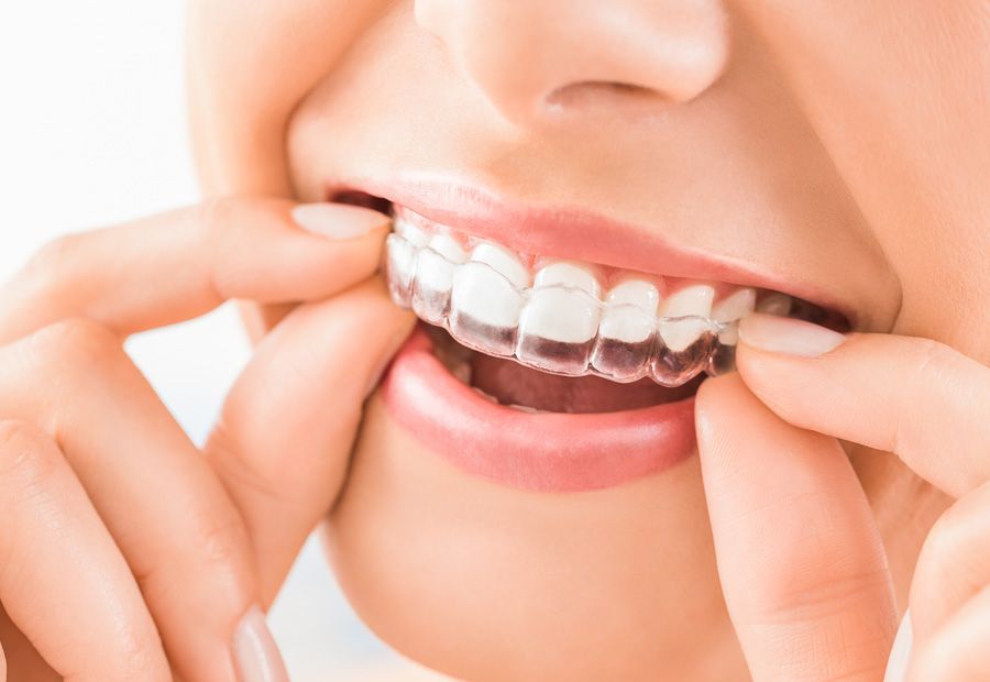 Invisalign