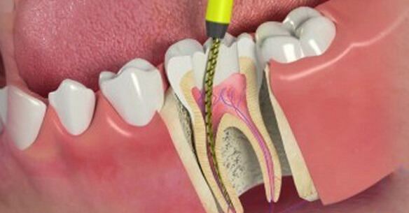 Root Canal